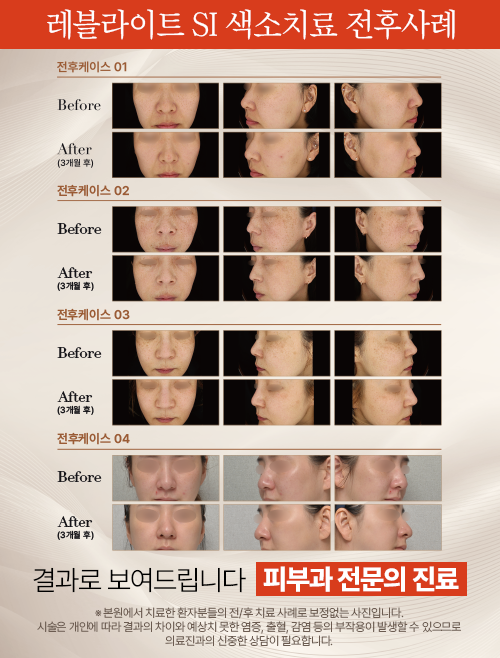 색소치료케이스1