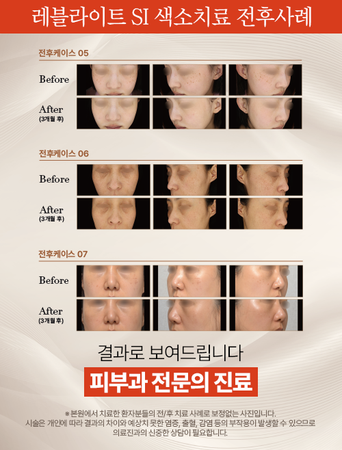 색소치료케이스2